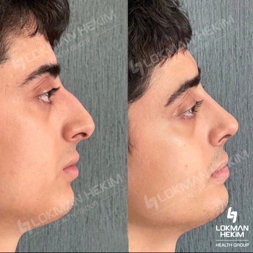 رأب و تجميل الحاجز الأنفي صور قبل وبعد